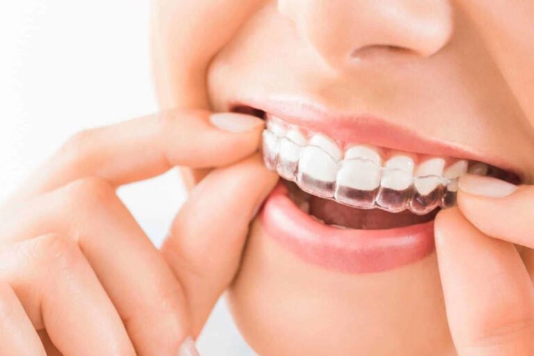 ¿Cuándo es necesaria una guarda oclusal? 