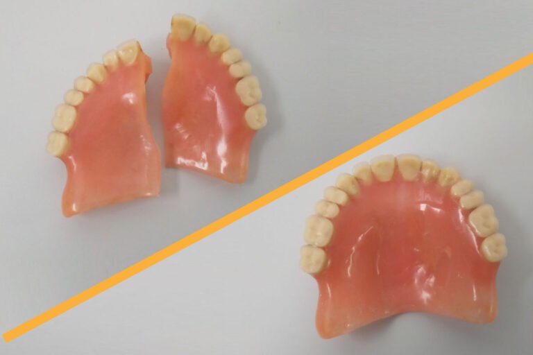 ¿Se puede reparar una prótesis dental rota?